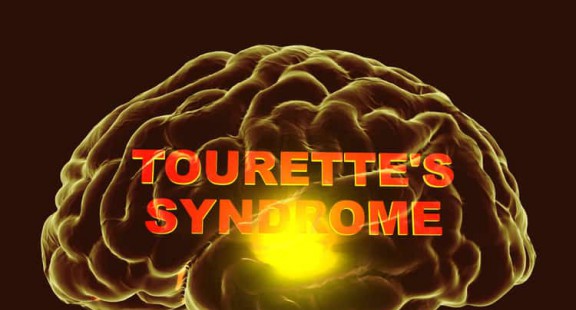Hội chứng Tourette: Một góc nhìn mới