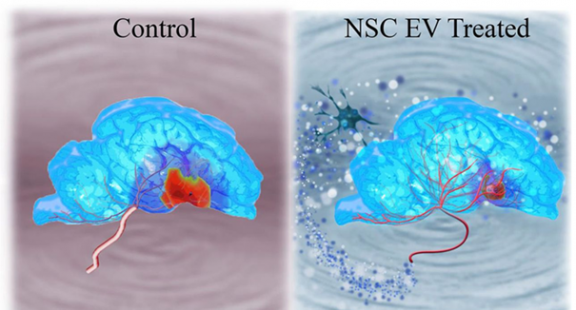 Exosome tiết từ tế bào gốc có thể điều trị đột quỵ