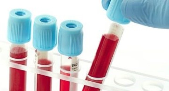 Ireland thử nghiệm lâm sàng để nghiên cứu Alpha-1-Antitrypsin cho nhiễm trùng nặng