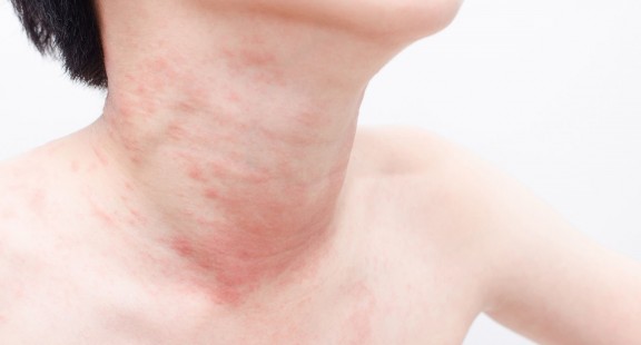 Triệu chứng phát ban da có thể là dấu hiệu cảnh báo của Covid-19