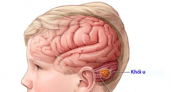 Có thể tái sử dụng thuốc điều trị ung thư bạch cầu Asen để điều trị ung thư não ở trẻ em