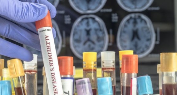 Xét nghiệm máu mới mang nhiều triển vọng trong chẩn đoán bệnh Alzheimer