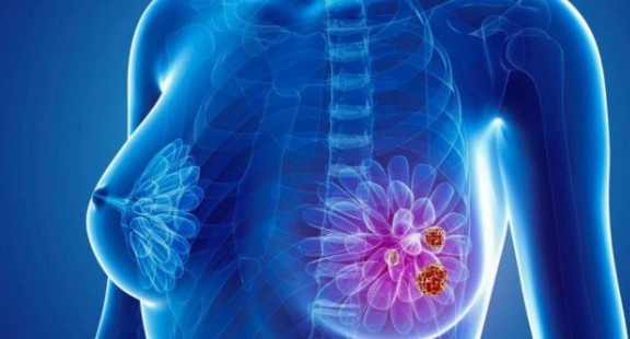 Cảm biến sinh học điện hóa vi lưu giúp chẩn đoán sớm ung thư vú