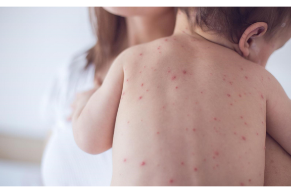 Bệnh đậu mùa giết hàng tỉ người và cách mà y học đánh bại chúng