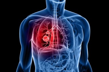 Israel: Phát triển phương pháp mới chữa ung thư phổi