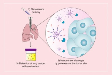 Cảm biến nano giúp phát hiện sớm u phổi