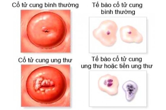 Giấm: Thuốc thử ung thư cổ tử cung