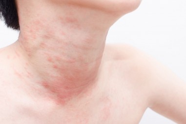 Triệu chứng phát ban da có thể là dấu hiệu cảnh báo của Covid-19