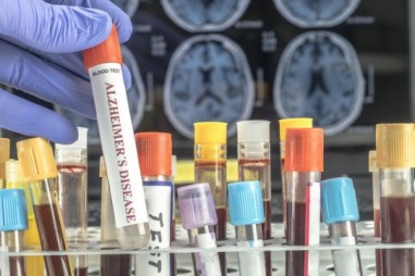Xét nghiệm máu mới mang nhiều triển vọng trong chẩn đoán bệnh Alzheimer