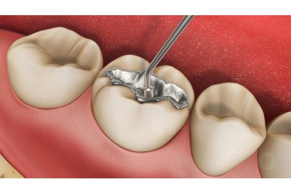 FDA cảnh báo nguy cơ từ chất trám răng có chứa thủy ngân