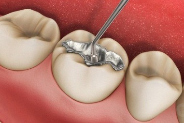 FDA cảnh báo nguy cơ từ chất trám răng có chứa thủy ngân