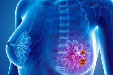 Cảm biến sinh học điện hóa vi lưu giúp chẩn đoán sớm ung thư vú