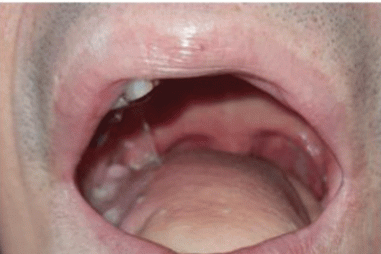 Tái tạo lưỡi trong điều trị ung thư