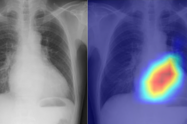 Mô hình AI chuyển hóa hình ảnh chụp X-quang thành công cụ chẩn đoán tim mạch